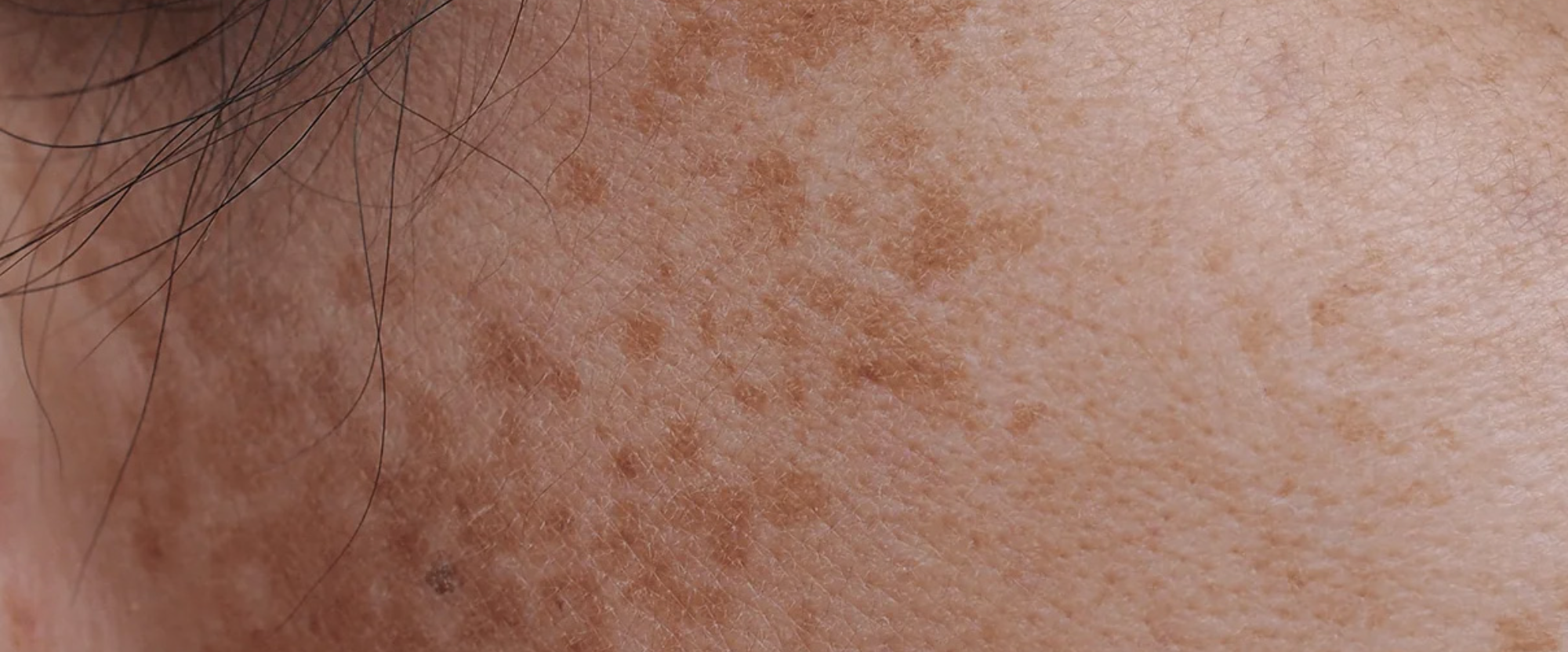 MELASMA